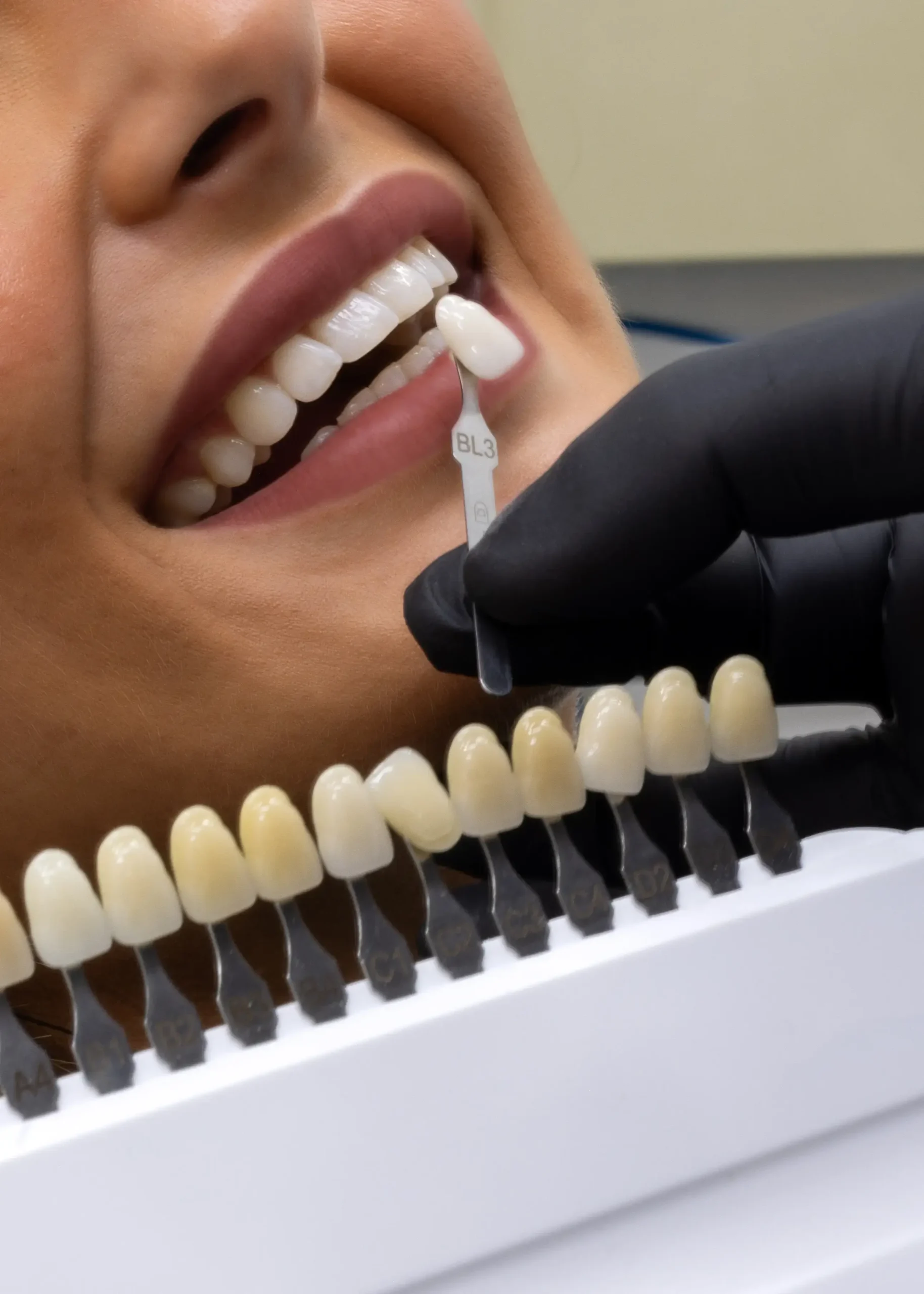 Porcelain Ceramic Veneers